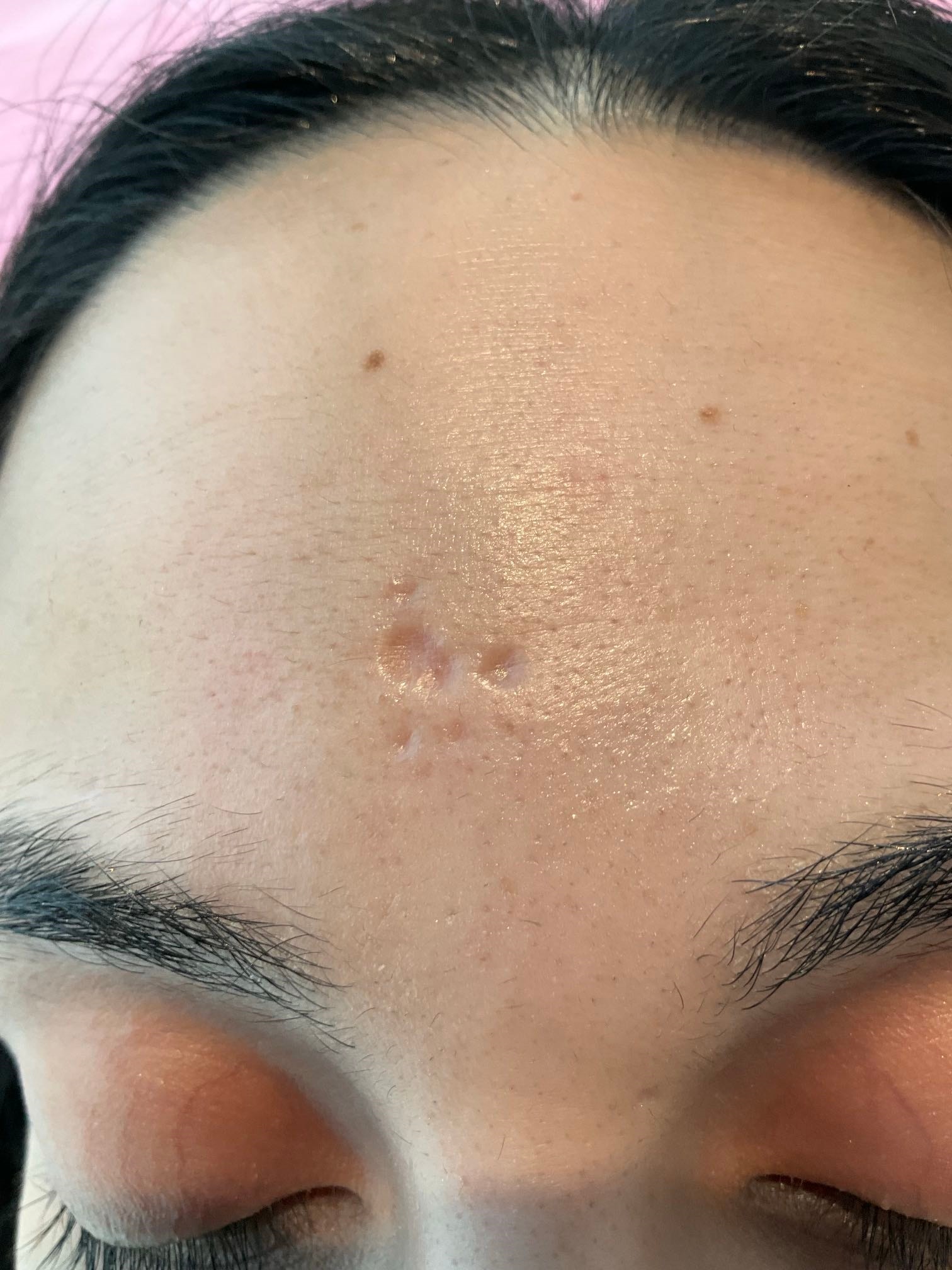 Close-up clinical before and after photographs showing forehead scar texture and skin surface quality at four-month review