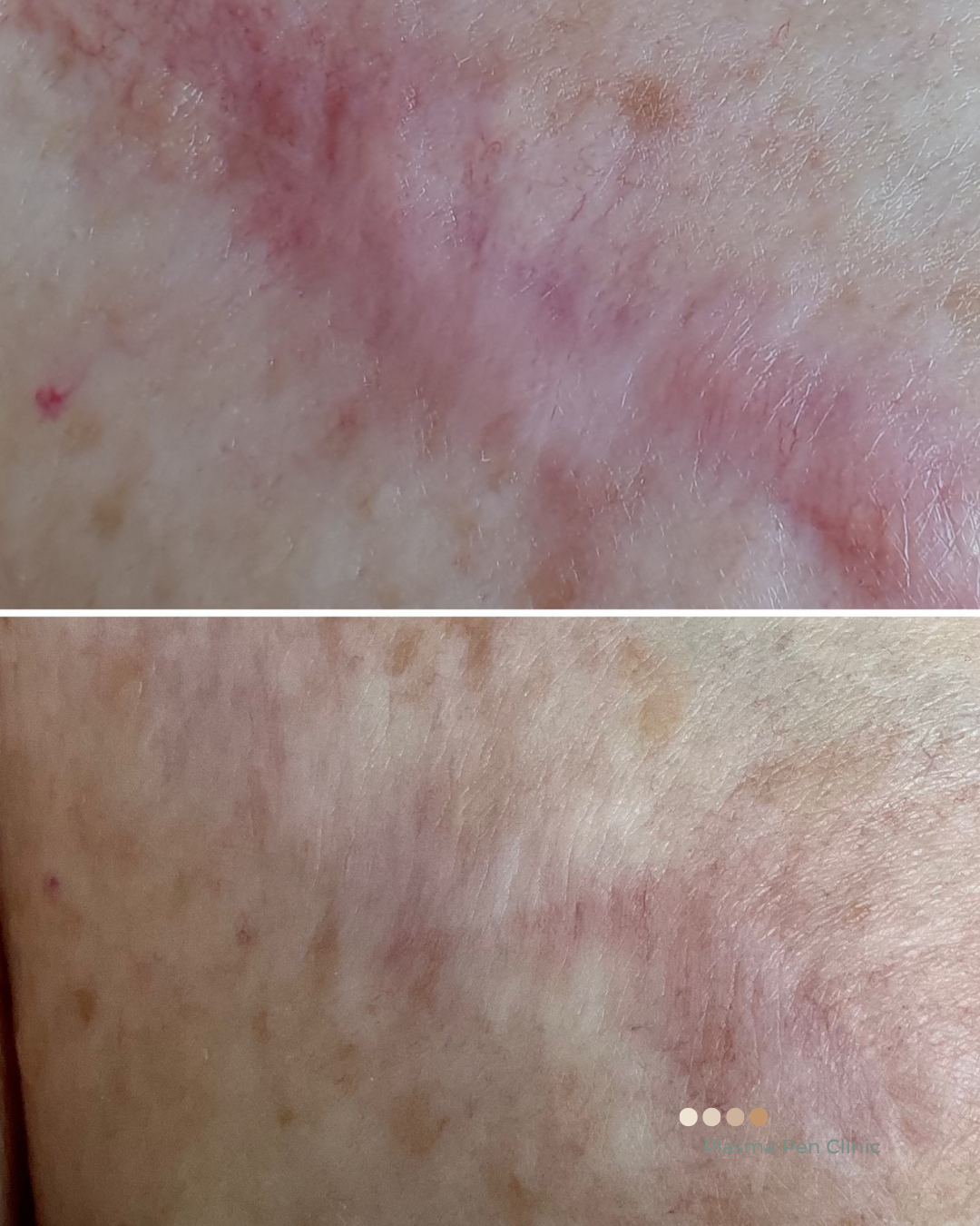 Before and after scar reduction treatment result, redness and scar tissue visibly reduced