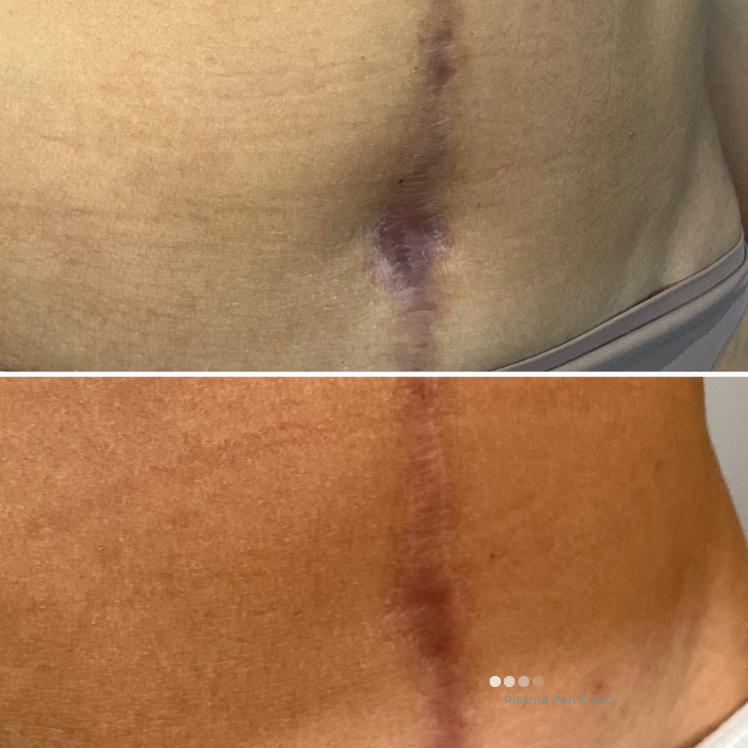 Before and after scar reduction treatment result, surgical scar visibly reduced