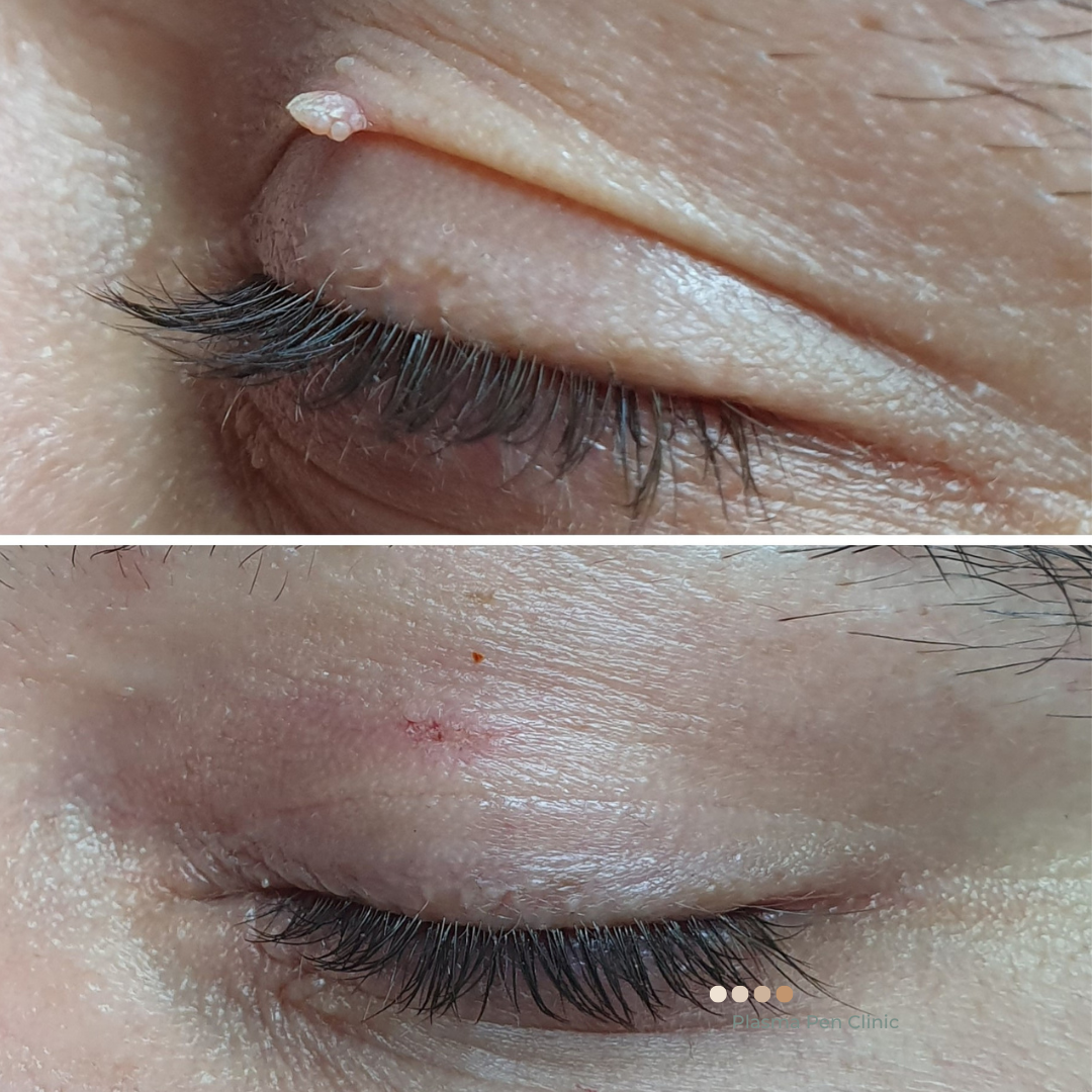 Before and after Plasma Pen skin tag removal on eyelid, skin tag visible before, smooth skin after treatment