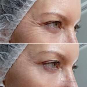 Fibroblast Skin Tightening Treatments | Plasma Pen Clinic Sydney