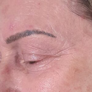 Before Treatment