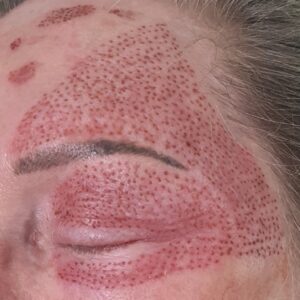 After Treatment